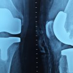 Chirurgien Orthopédiste : quel est son rôle ?